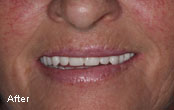 Cosmetic Dentures Before After Photos